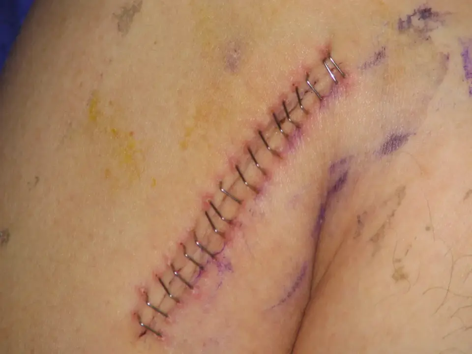 Point de suture qui saute, que faire ?